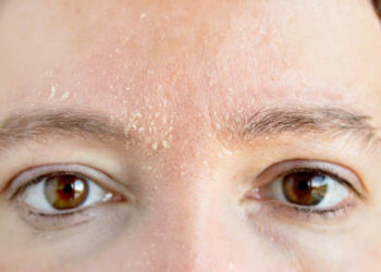 woman with symptom of atopic dermatitis on brow and brows