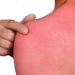 A man with reddened, itchy skin after sunburn. Skin care and protection from the sun's ultraviolet rays.; Shutterstock ID 576948970; Purchase Order: -