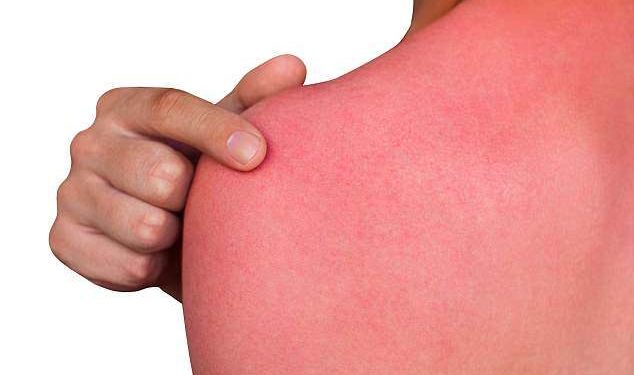 A man with reddened, itchy skin after sunburn. Skin care and protection from the sun's ultraviolet rays.; Shutterstock ID 576948970; Purchase Order: -
