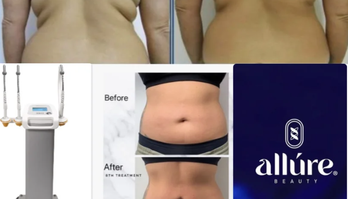 “Allure Beauty” prezanton aparaturën 3 në 1: heqje celuliti, shkrirje dhjami dhe tonifikim muskuli si me magji