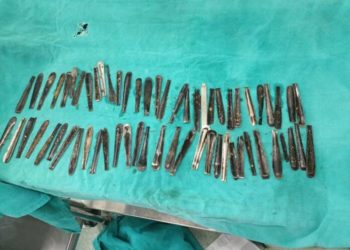 spoon handles removed from stomach. Credit: Dr Rakesh Khurana