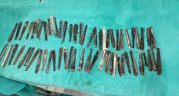 spoon handles removed from stomach. Credit: Dr Rakesh Khurana