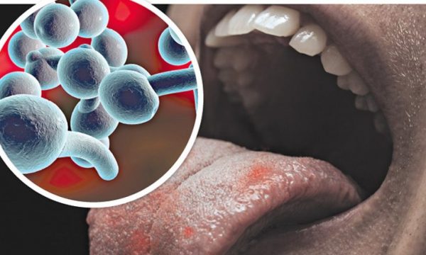 Katër mënyra për ta kuruar shpejt mykun e gojës