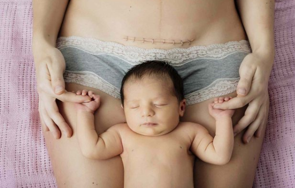 Lindja me prerje cezariane: Kur është e nevojshme dhe çfarë duhet të dini
